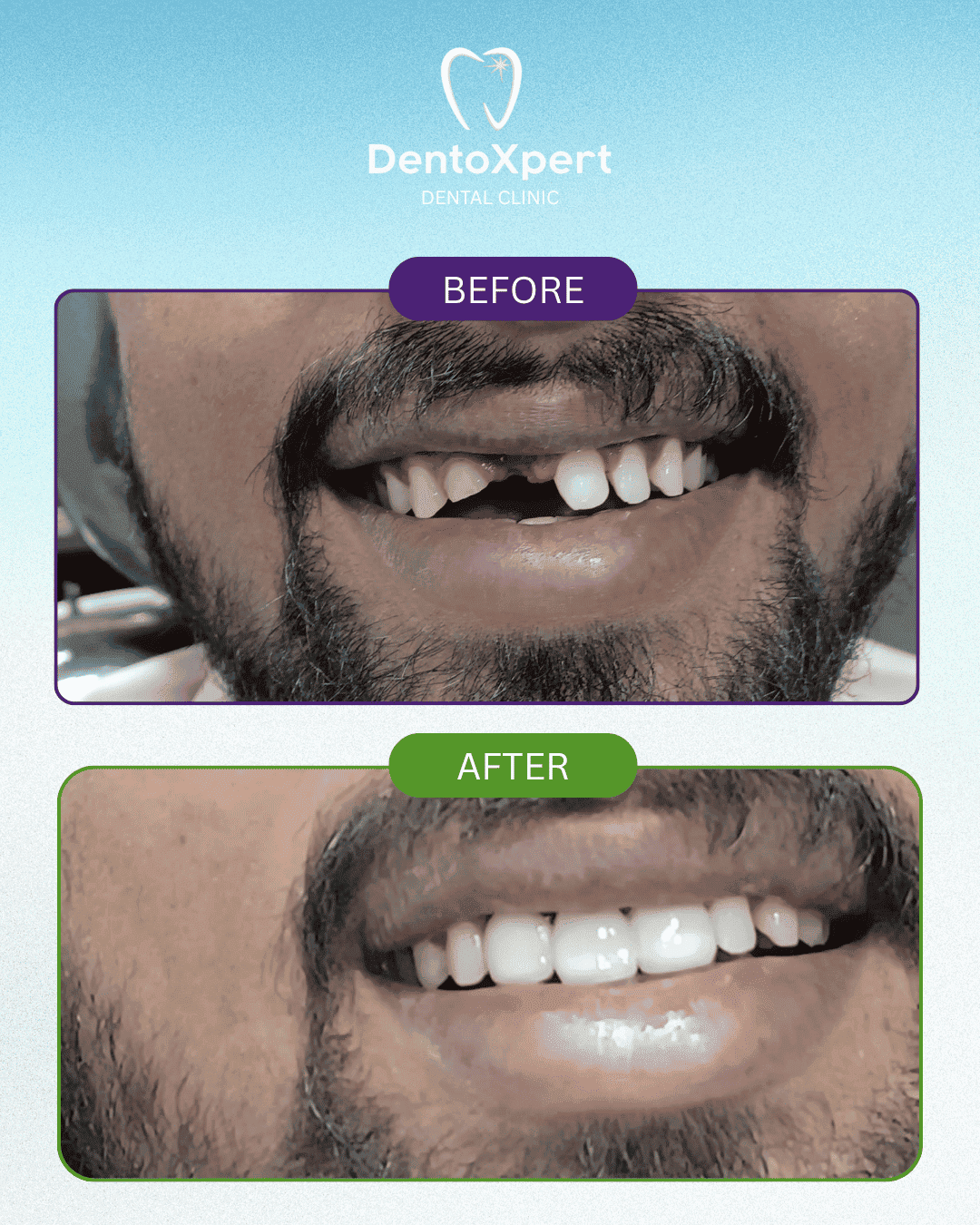 Before and after dental treatment result at DentoXpert Dental Clinic in Thane